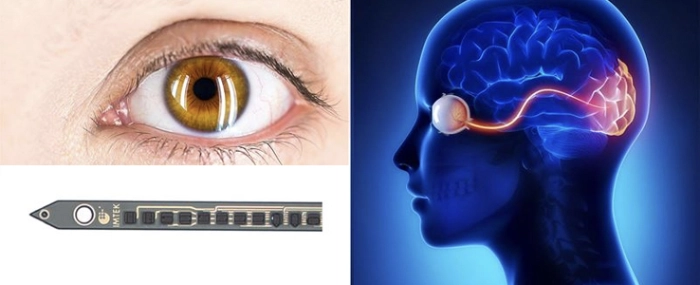 vision-implant
