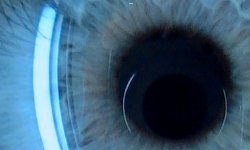 via_Wiki_eye_iris