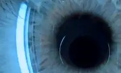 via_Wiki_eye_iris